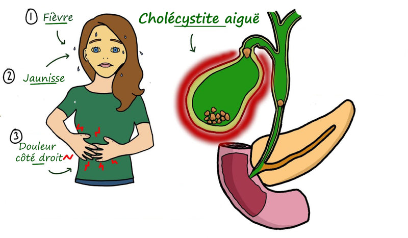 La cholécystite aiguë - Une inflammation de la vésicule biliaire