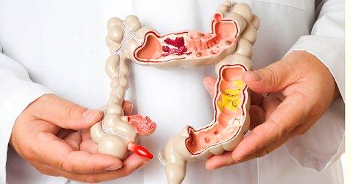 Le Syndrome de l’Intestin Irritable (SII)