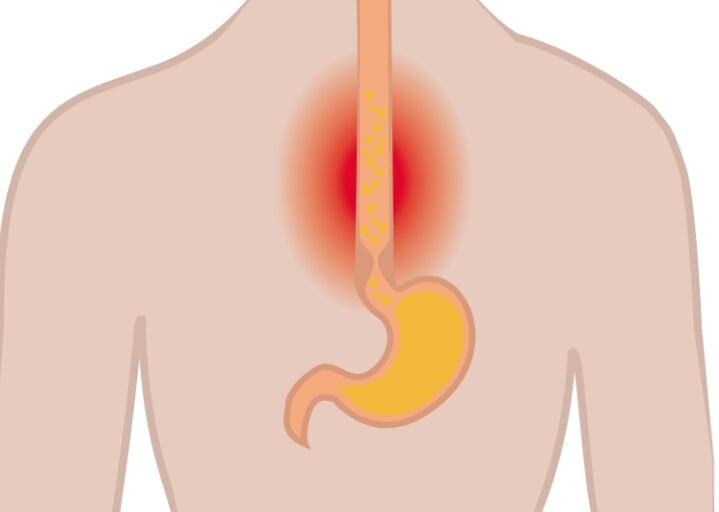 L’œsophagite à éosinophiles