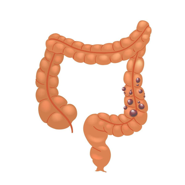 La maladie diverticulaire