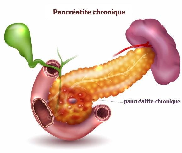 La pancréatite chronique